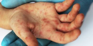 Se cuadriplicaron los casos de sarampión en el mundo en lo que va de 2019