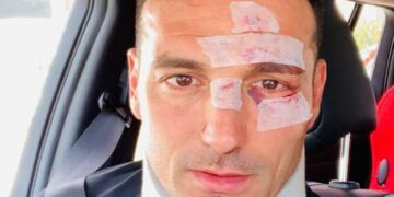 Susto y alta para Scaloni, DT de la Selección nacional