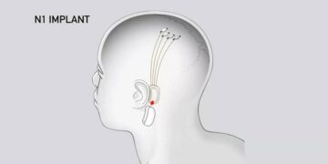 Cómo funciona el implante anticonceptivo que repartirá la Municipalidad