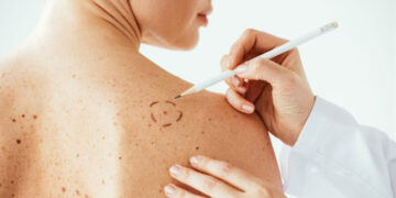 Lanzan una campaña nacional para prevenir el melanoma