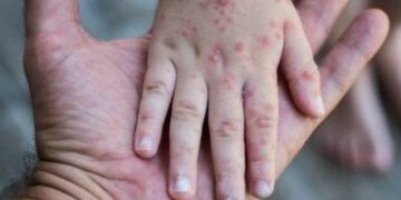 Ya suman 38 los casos de sarampión en el país
