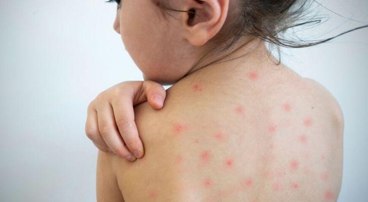 El Ministerio de Salud recomienda vacunar para controlar el brote de sarampión