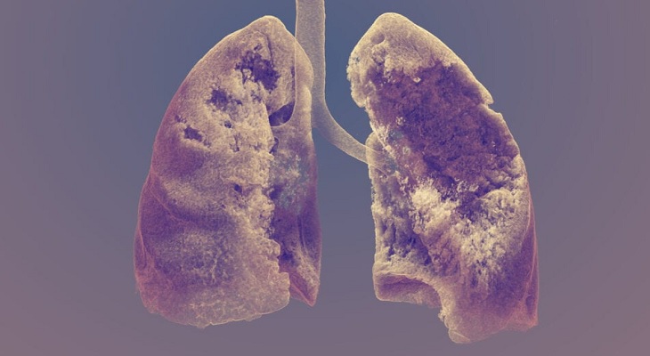 Un pulmón devastado por Covid-19 ganó un concurso de fotografía científica