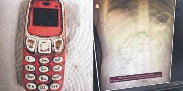 Un preso se tragó un celular y estuvo al filo de la muerte