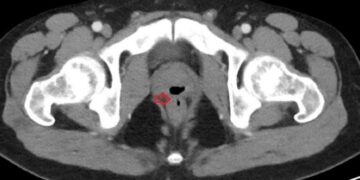 Detectan el primer caso clínico de un hombre que eyaculaba por el ano