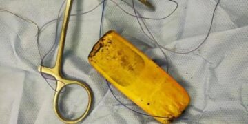 Tuvo un teléfono en el estómago durante seis meses