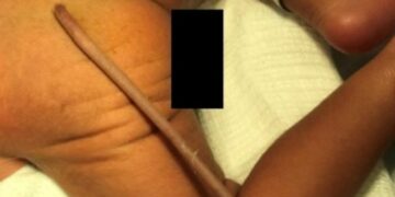 Un bebé nació con una cola de 12 centímetros de largo