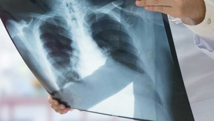 Un estudio reveló que más de 10.000 personas murieron en 2020 por cáncer de pulmón