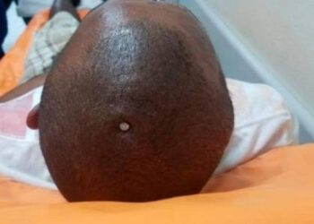 Se perforó el cerebro con un clavo porque sentía que su cerebro «estaba flojo»