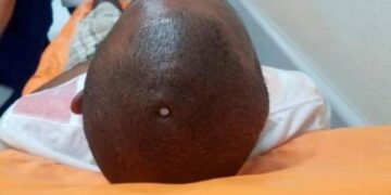 Se perforó el cerebro con un clavo porque sentía que su cerebro «estaba flojo»