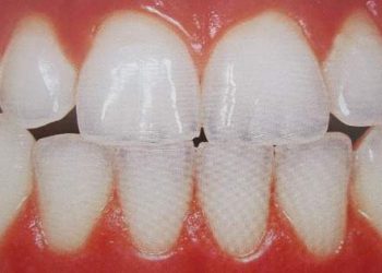 Trucos para fortalecer el esmalte de los dientes