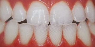 Trucos para fortalecer el esmalte de los dientes