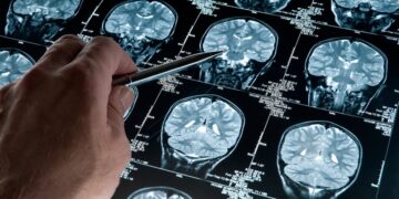 Un software nacional podría diagnosticar de forma precoz el Alzheimer