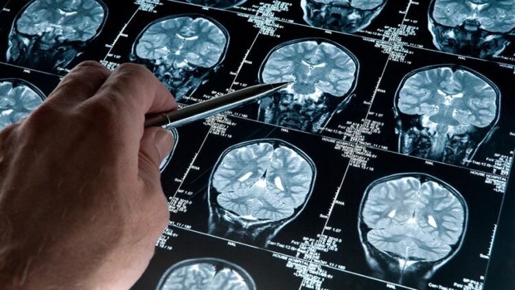 Un software nacional podría diagnosticar de forma precoz el Alzheimer