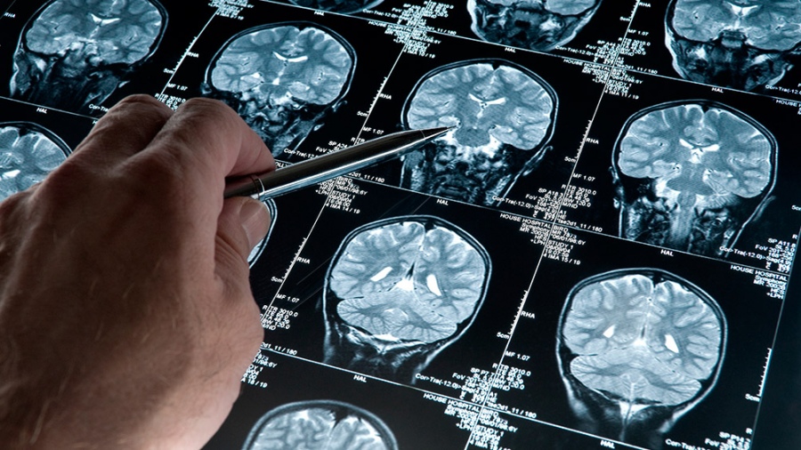 Un software nacional podría diagnosticar de forma precoz el Alzheimer