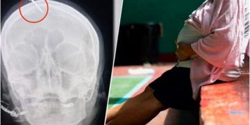Por consejo de una curandera, una embarazada se martilló un clavo en la cabeza para tener un hijo varón