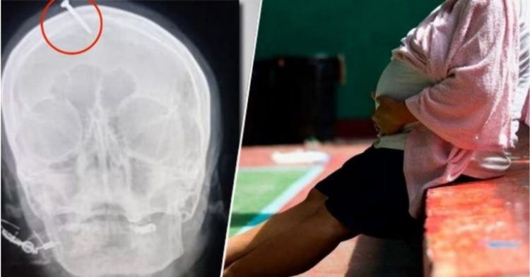 Por consejo de una curandera, una embarazada se martilló un clavo en la cabeza para tener un hijo varón