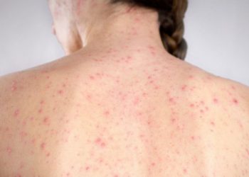 Desde el ministerio de Salud informaron un “posible caso” de sarampión en Caba