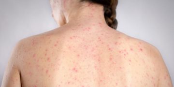 Desde el ministerio de Salud informaron un “posible caso” de sarampión en Caba