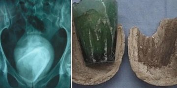 Creyó que tenía infección urinaria, pero le sacaron algo impensado de la vejiga