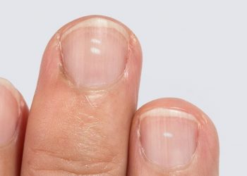 Estos son los síntomas que podrían denotar la falta de calcio en los huesos