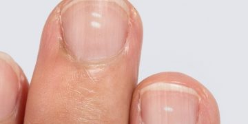 Estos son los síntomas que podrían denotar la falta de calcio en los huesos