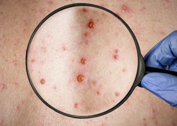 Confirman el segundo caso de viruela del mono en la Argentina