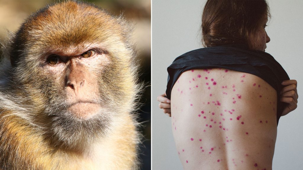 Viruela del mono: qué es, cuáles son sus síntomas y cómo se transmite