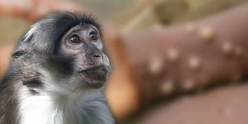 Se confirmó el primer contagio de viruela del mono en Argentina