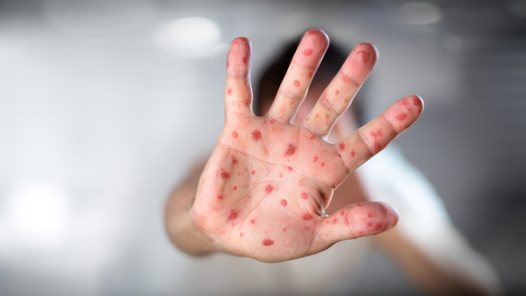 Salud reportó un caso sospechoso de viruela símica en el país