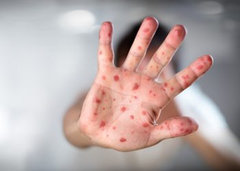 Salud reportó un caso sospechoso de viruela símica en el país