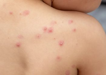 Nueva enfermedad infrecuente