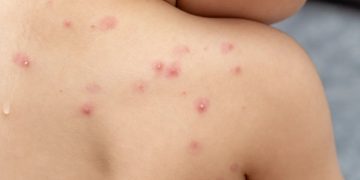 Nueva enfermedad infrecuente