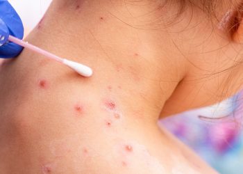 La OMS alerta por la expansión de la viruela del mono