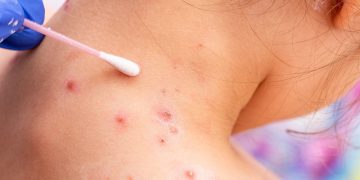 La OMS alerta por la expansión de la viruela del mono