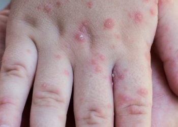 Reino Unido confirmó la transmisión local de la viruela del mono