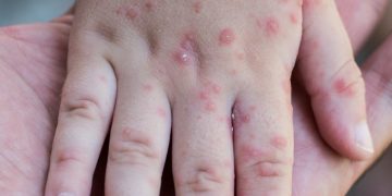 Reino Unido confirmó la transmisión local de la viruela del mono