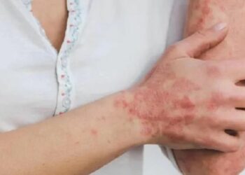 Confirman el primer caso de viruela símica en Córdoba