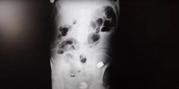 Fue a al médico por un dolor de panza y lo tuvieron que operar para sacarle 233 objetos del estómago