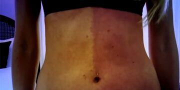 Fue al médico por una extraña marca de nacimiento y descubrió que es su propia hermana gemela