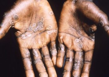 Estado de emergencia