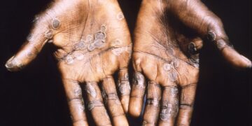 Estado de emergencia