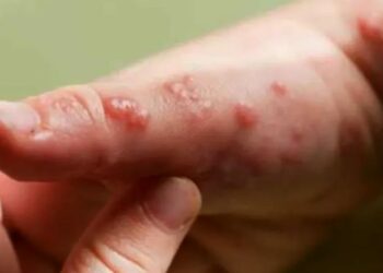 Se confirmaron dos nuevos casos de Viruela del Mono