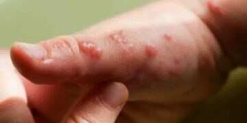 Se confirmaron dos nuevos casos de Viruela del Mono