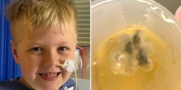 Tuvo tos durante cinco años, fue al médico y le quitaron de la garganta algo impensado