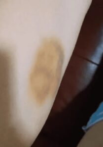 Asegura que le apareció el rostro de Jesús en un moretón