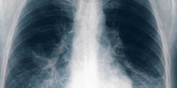 Legionella: se sumaron 8 nuevos casos en Tucumán