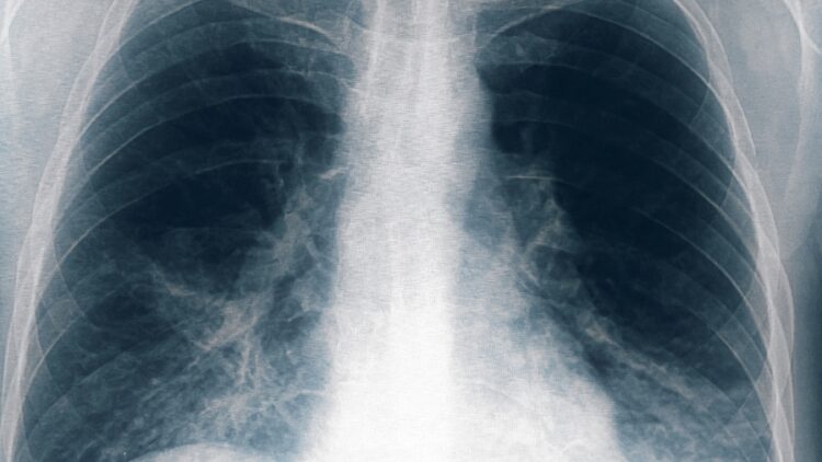 Legionella: se sumaron 8 nuevos casos en Tucumán