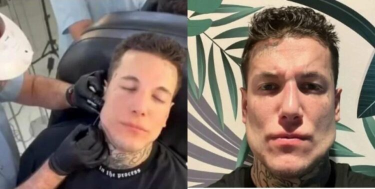 Alex Caniggia se operó la mandíbula y sorprendió con su fuerte cambio de look