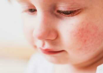 Advierten que la dermatitis atópica afecta al 30% de los menores